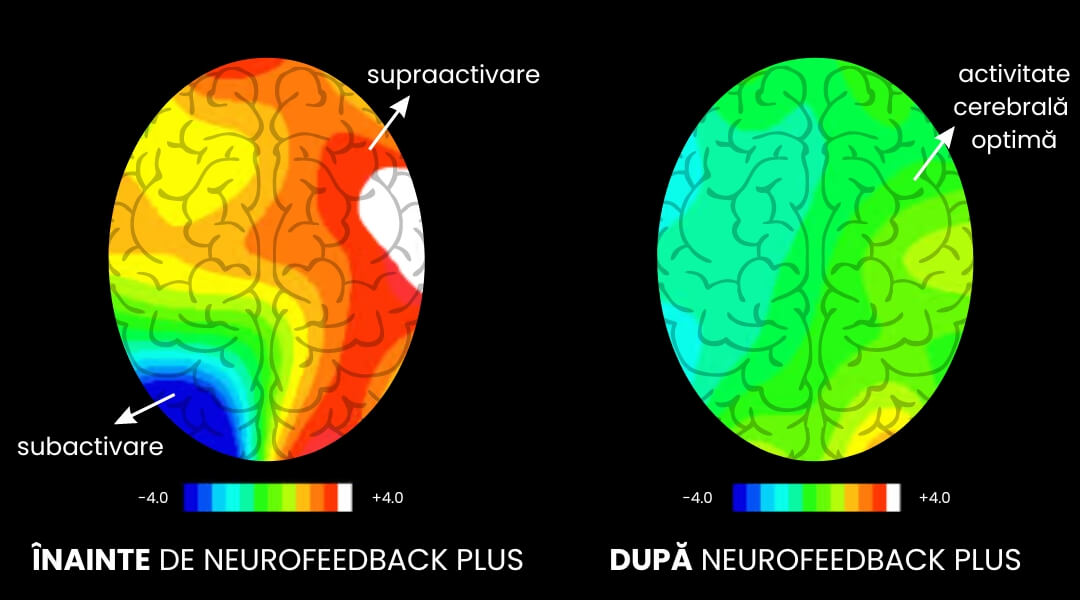 Activitate cerebrală înainte și după Antrenamente cerebrale