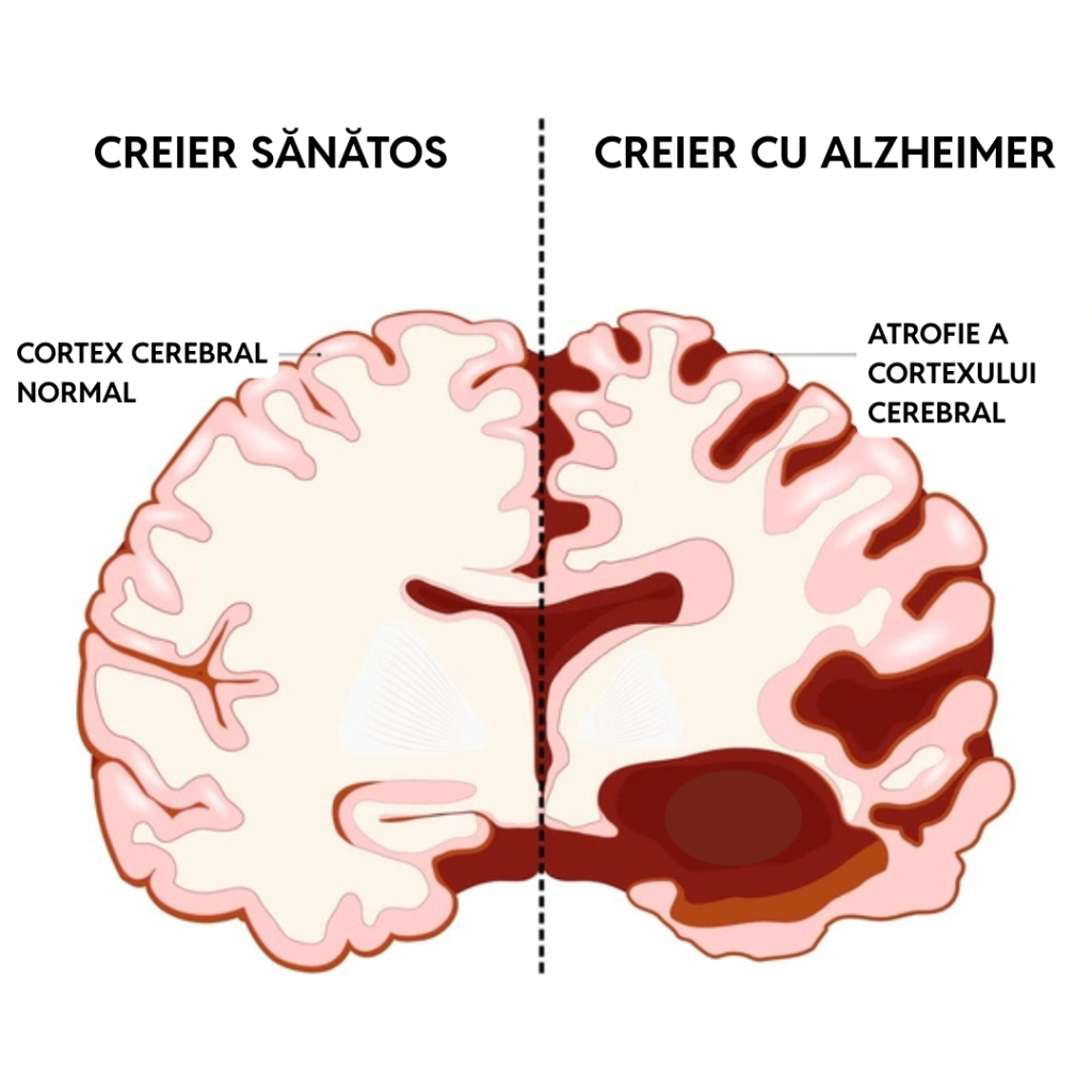 Comparație între un creier sănătos și un creier cu boala Alzheimer